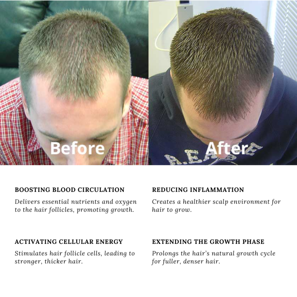 Before and after comparison showcasing hair growth improvement using the RLB LED Mask & Laser Hair Growth System, highlighting benefits such as boosted blood circulation, reduced inflammation, activated cellular energy, and extended growth phase for healthier hair.