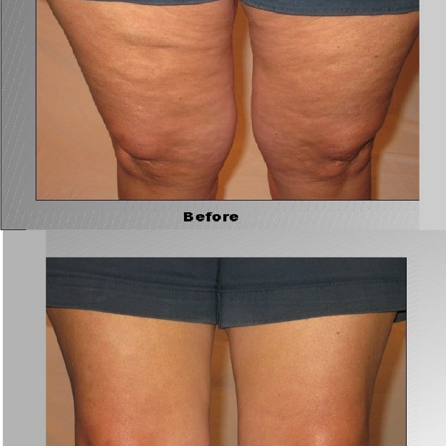 Skinnies Instant Thigh Lifting Tape