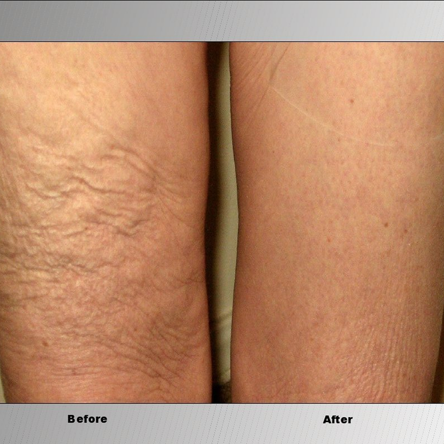 Skinnies Instant Thigh Lifting Tape