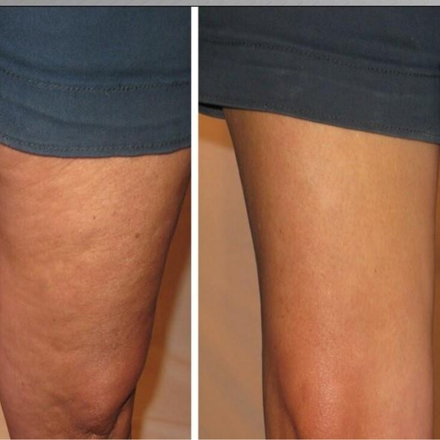 Skinnies Instant Thigh Lifting Tape