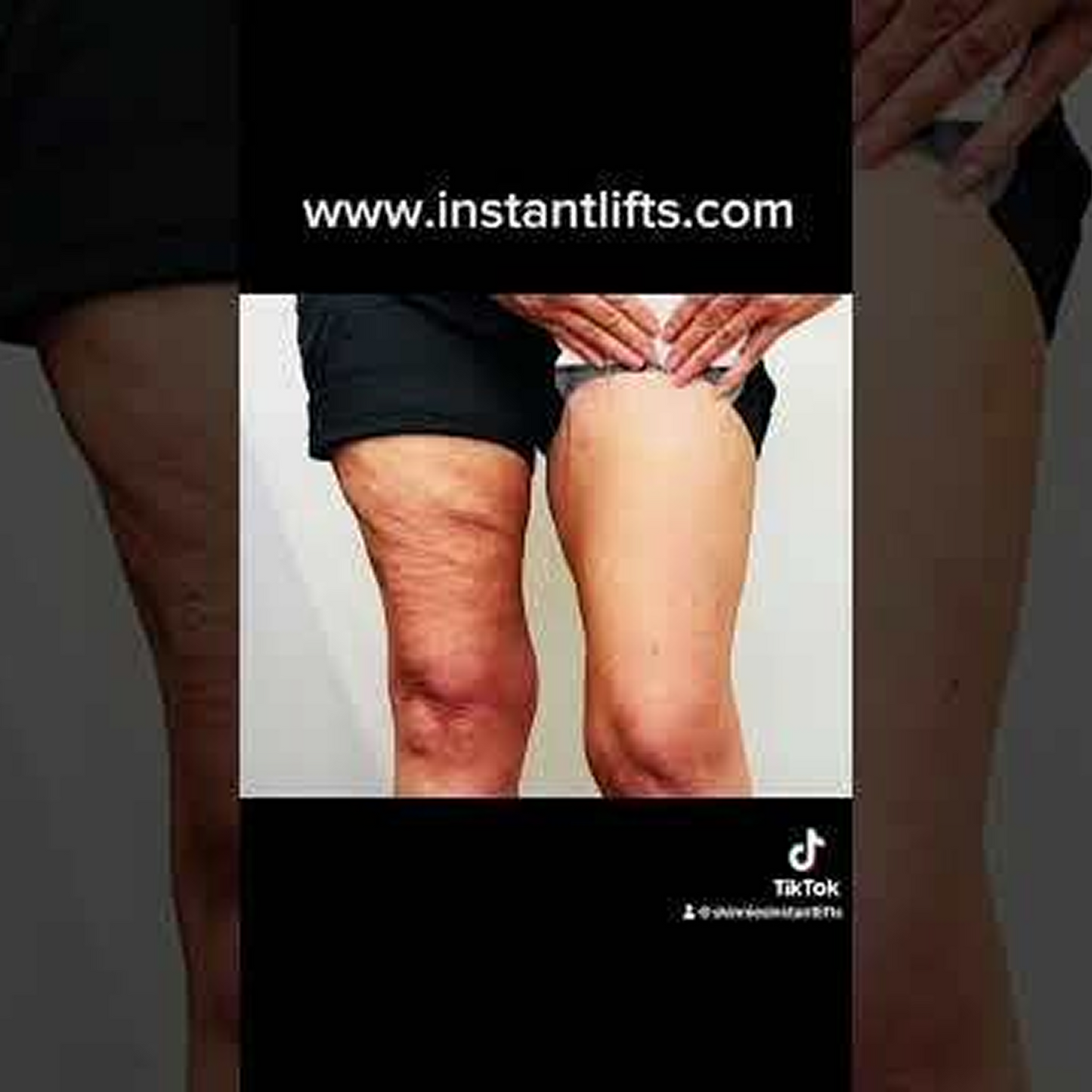 Skinnies Instant Thigh Lifting Tape